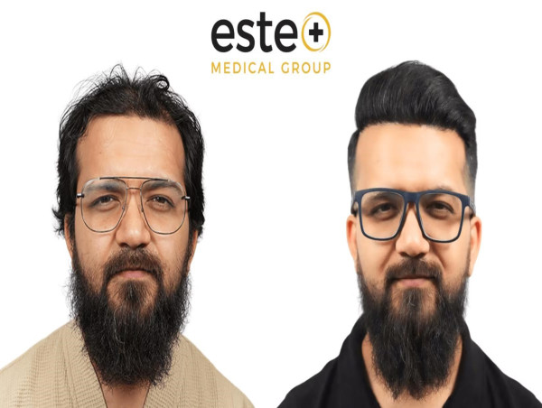 Este Medical Group Expands Hair Loss Consultations in Nottingham for Advanced Robotic DHI Transplants