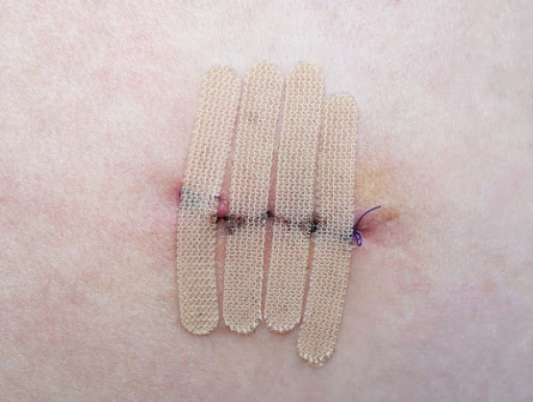 Stem Health Plus Provides Expert Care for Those Experiencing Post-Surgical Healing