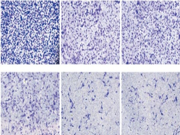 Chinese Neurosurgical Journal Report Identifies FAM111B as Key Molecular Driver of Glioma Progression