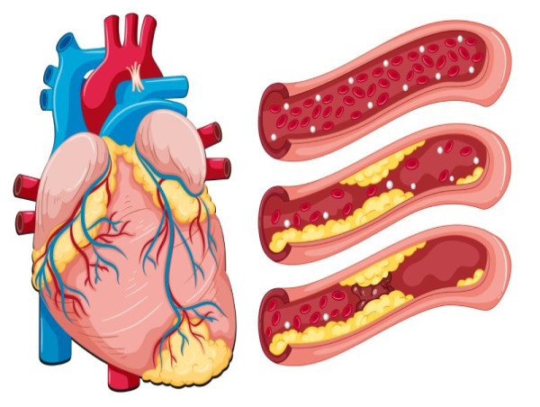 Atherosclerosis Market to Reach USD 62.2 Billion by 2035, Growing at 2.7% CAGR