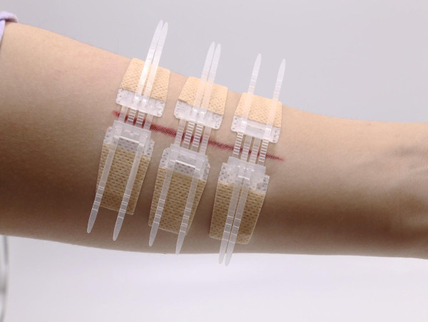  Non-invasive Surgical Wound Closure Market Growth at 4.1% CAGR 