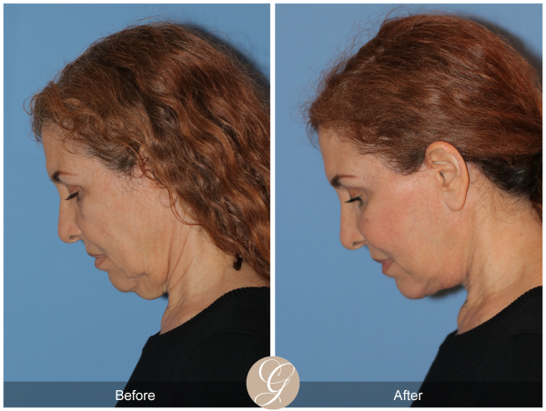  Dr. Kevin Sadati Present his Preservation Facelift Technique at Vegas Cosmetic Surgery and UC Irvine 