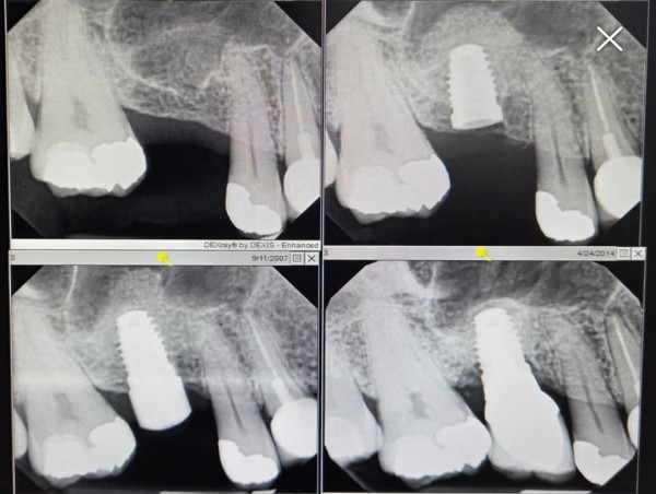  Greater New York Dental Meeting 2024 - Dental Implants, Soft Tissue & Bone Grafts to Rehabilitate Oral Health and Smile 