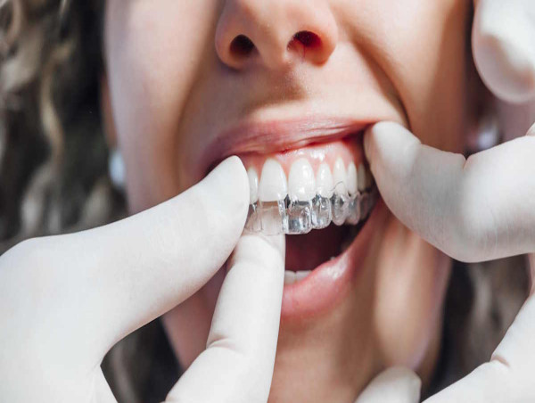  Bekmezian Orthodontics Brings Advanced Invisalign Solutions to Costa Mesa 