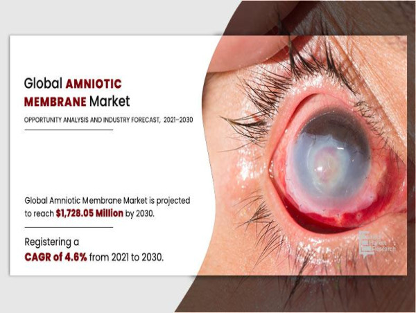  Amniotic Membrane Market Poised for Steady Growth, Reaching $1.7 Billion by 2030 