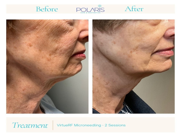  Undo Summer Skin Damage: Polaris Offers Mid-Summer Facial Rescue Treatments 