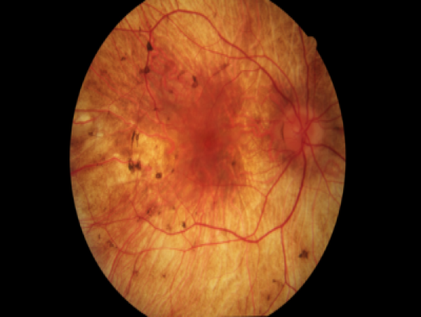 Choroideremia Market Epidemiology Report 2025-2035: Pipeline Therapies, Drugs Sales, and Regional Outlook