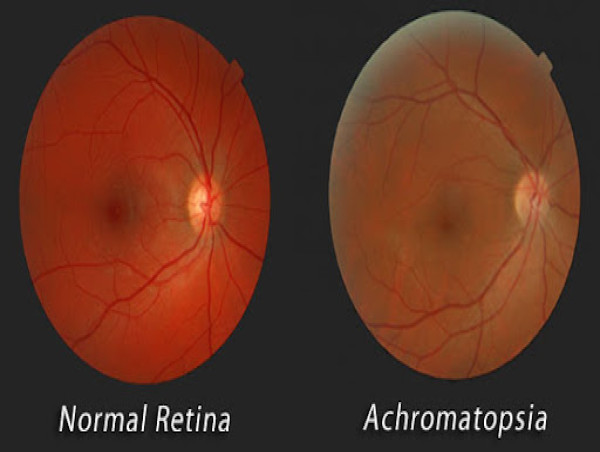 Achromatopsia Market Epidemiology Report 2025-2035: Pipeline Therapies, Drugs Sales, and Regional Outlook