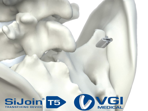 VGI Medical Launches T5™: A Sterile-Packed, Single-Use Titanium Implant System for Posterior SI Joint Fusion