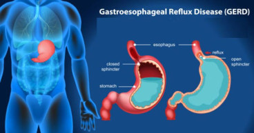 Gastroesophageal Reflux Disease Treatment Devices Market to See Huge Growth by 2030 | Medigus Ltd., Torax Medical, Inc.