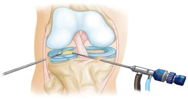 Precision in Motion: Unveiling the Future with Arthroscopic Implants, and Industry Forecast, 2023-2032