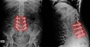 Failed Back Surgery Syndrome Market Report 2023-2033 | Industry Size, Growth and Latest Insights