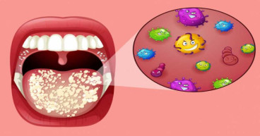 Candidiasis Market Expected to Expand at a Steady 2023-2030 | Basilea Pharmaceutica Ltd., Astellas Pharma Inc, Pfizer