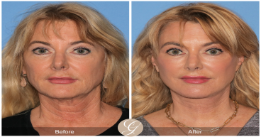 Dr. Kevin Sadati has been recognized as one of the top facelift surgeons in California by the Los Angeles Times in 2023
