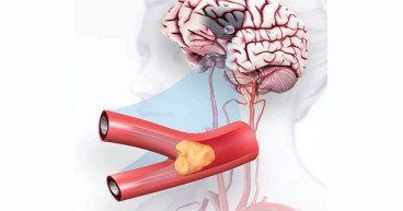 Ischemic Stroke Market Size Expected to Reach US$ 5.2 Billion by 2034
