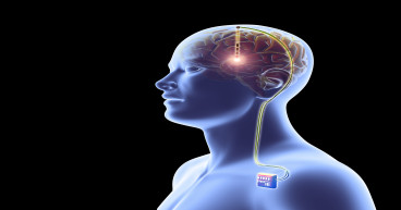 Asia Pacific Brain Implants Market Size, Share, Competitive Landscape and Industry Forecast, 2023-2032