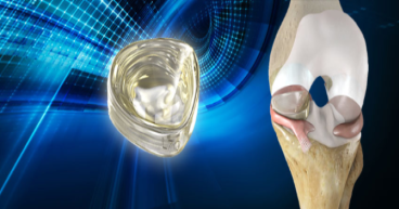 Collagen Meniscus Implant Market Report Explores the Market Revenue status and outlook 2023-2030| Orthonika, Biofixt