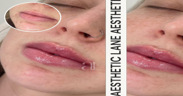 Black Rock's Premier Cosmetic Injectables Clinic Aesthetic Lane Launches Innovative Treatments