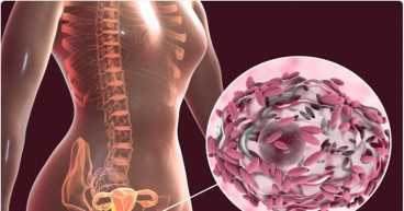 Bacterial Vaginosis Market Report 2023-2033 | Industry Size, Growth and Latest Insights