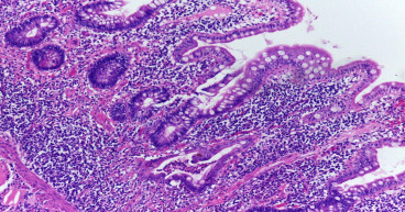 Pouchitis Market Size, Analysis, Industry Statistics and Latest Insights Till 2034