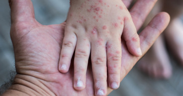 Rubella Market is Projected to Grow at a CAGR of 4.31% from 2024-2034 | IMARC Group