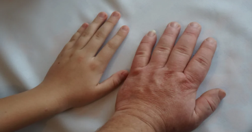 Acromegaly Treatment Market See Incredible Growth 2024-2031 with Scope, Size, Share Trends Analysis| Midatech Pharma PLC
