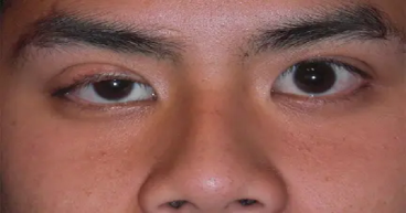 Myasthenia Gravis Market Size, Epidemiology, Analysis & Trends 2024-2034