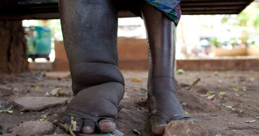  Elephantiasis Market Size, Analysis, Industry Statistics and Latest Insights Till 2034 