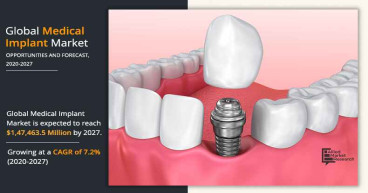 Medical Implant Market Current Scenario with Future Aspect Analysis | CAGR of 7.2% from 2020 to 2027.