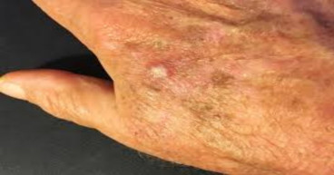 Actinic Keratosis Market is expected to reach US$ 12.23 Bn by 2031 with a CAGR of 4.9% | Almirall, S.A, Athenex.