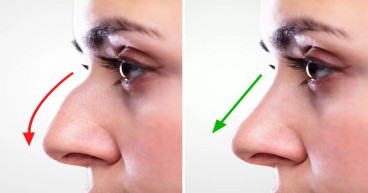 Rhinoplasty Market Projected To Witness Substantial Growth, 2024-2031: Stryker Corporation, SATELEC, Implantech, Koken