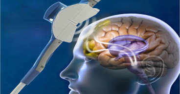 Transcranial Magnetic Stimulator Market Projected To Witness Substantial Growth, 2024-2031: BrainsWay, Nexstim Plc