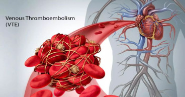 Venous Thromboembolism Market Size, Trends, Opportunities, Segmentation Overview By 2031 | Sanofi S.A, Bayer AG, Merck