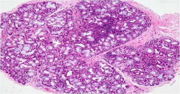 Sicca Syndrome (Sjogren) Market to Reach $548.77 Million, Globally, by 2032 at 5.7% CAGR | VMR