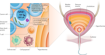 Muscle Invasive Bladder Cancer Therapeutics Market Trends, Opportunites By 2032 | Pfizer Inc, Merck & Co, AstraZeneca