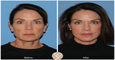Understanding the Recovery Process After a Preservation Facelift