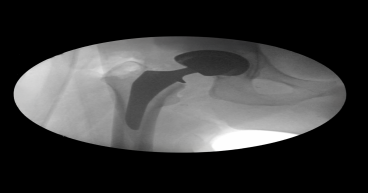 Corin Announces First Clinical Use of Icona™ Femoral Stem