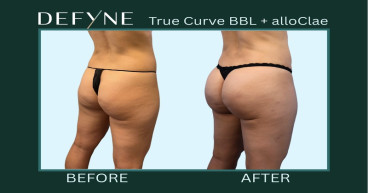 Defyne MD Unveils the Latest Breakthroughs in Fat Grafting Innovations
