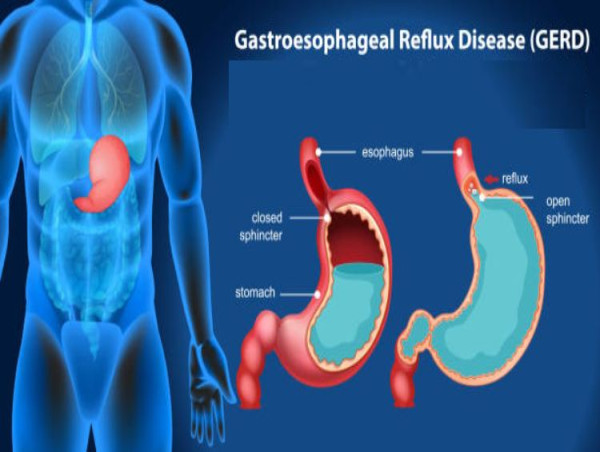 Gastroesophageal Reflux Disease Treatment Devices Market to See Huge ...