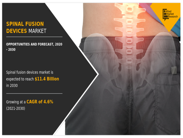 Spinal Fusion Devices Market: In-depth Analysis Of Industry Dynamics 