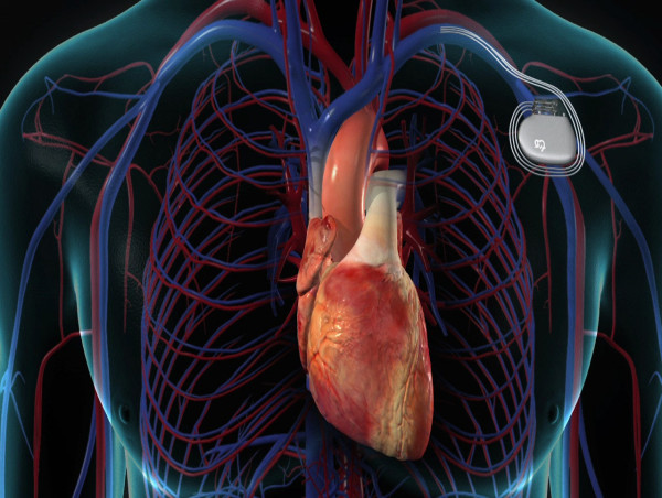 Cardiac Pacemaker Market Share Growth Status, Emerging Technology, and ...