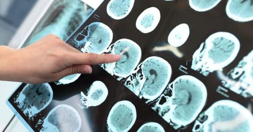  Actinogen Medical Enrolls Final Patient For Alzheimer’s Treatment Trial 