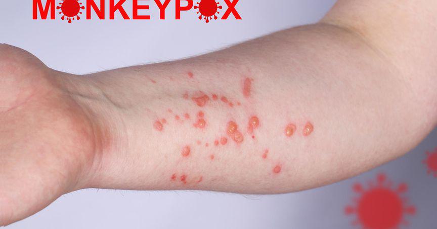  Monkeypox cases rising in Australia; Will healthcare giants be impacted? 