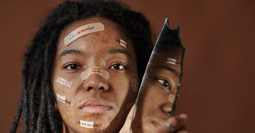 Understanding Acne: Definition, Causes, and Treatments