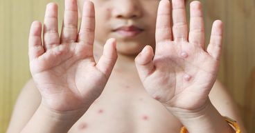 Latest on monkeypox outbreak: Which countries have reported it so far?