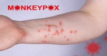 Monkeypox: Which is the worst hit country?