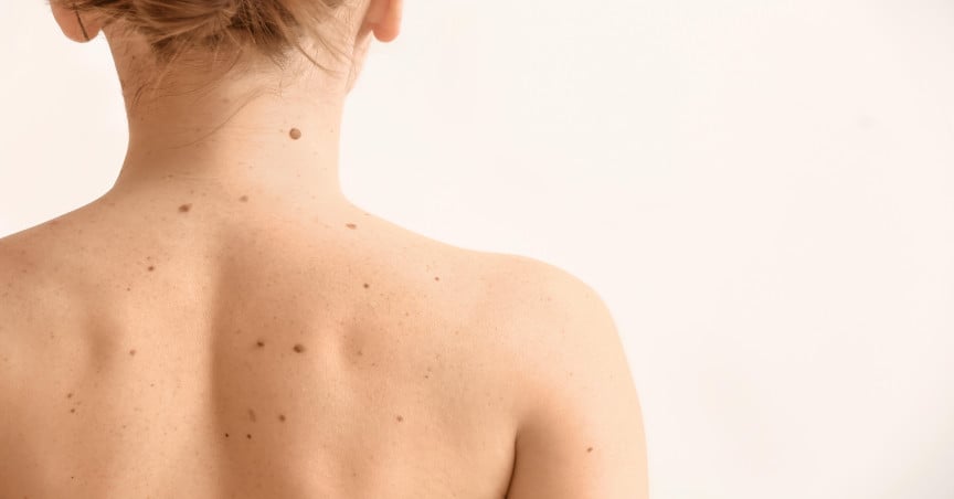 Young woman with moles on back