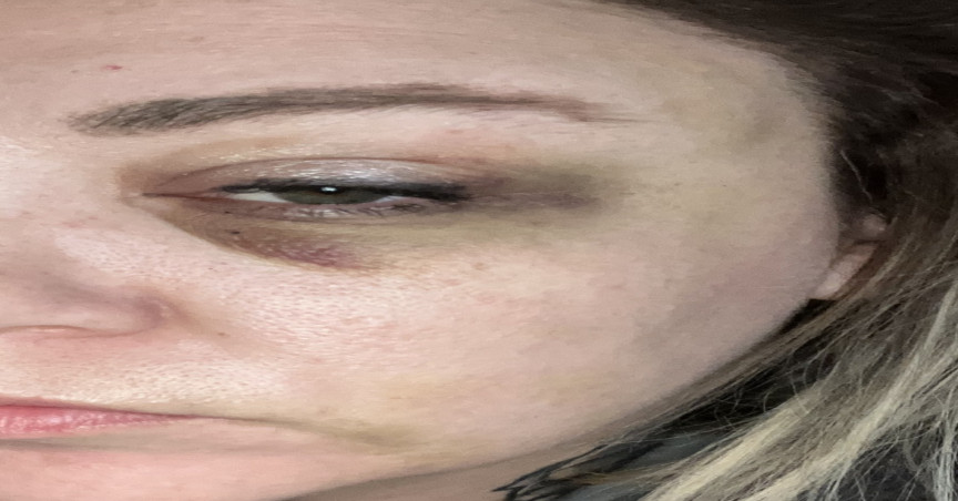 Bruising around a woman's eye