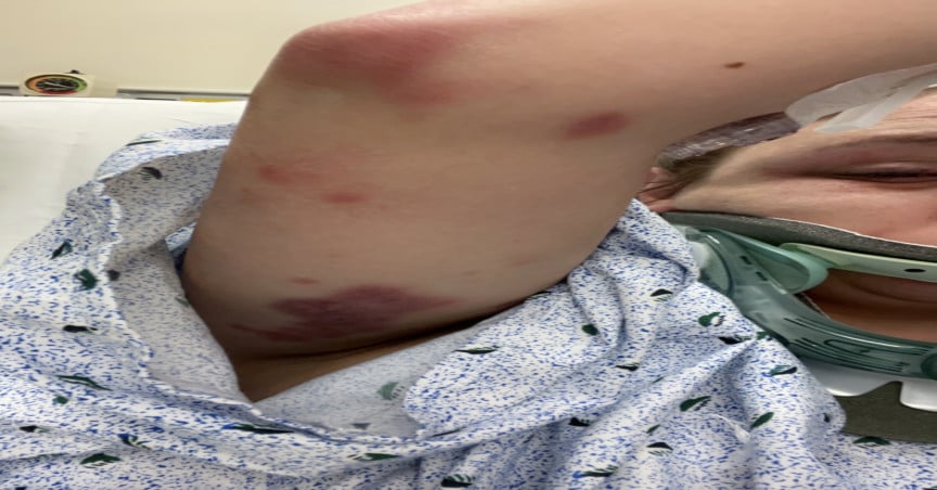 Woman in hospital with bruises on her arms and wearing a neck brace