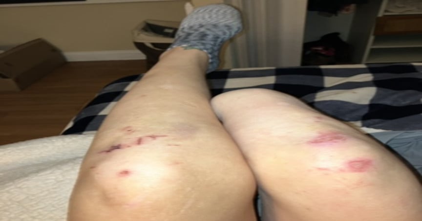 Bruising on a woman's legs, one of which has been amputate below the knee